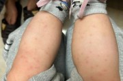 宝宝大腿外侧起红疹子怎么办_婴儿大腿外侧红疹子原因