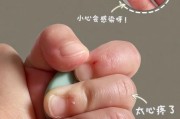 宝宝手上倒刺怎么办_如何预防宝宝倒刺