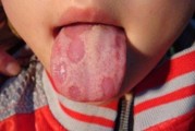 宝宝缺锌舌头图片_宝宝缺锌舌头有什么症状