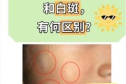宝宝脸上白块是什么_需要看医生吗