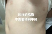 宝宝鸡胸早期症状图片_如何辨别