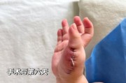 宝宝六指的原因_六指会遗传吗