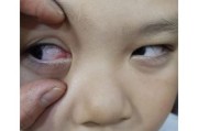 1岁宝宝眼睛有红血丝怎么办_1岁宝宝眼睛红血丝的原因