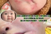 宝宝嘴上湿疹怎么办_宝宝嘴上湿疹小妙招