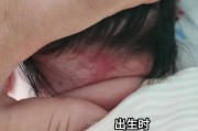 宝宝发丹的症状图片_宝宝发丹初期图片