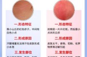 宝宝痱子图片_怎么快速消退