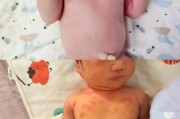 11个月宝宝出疹子症状_怎么办