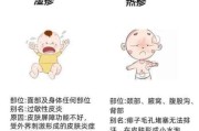 宝宝湿疹反复怎么办_肤专家真的有用吗