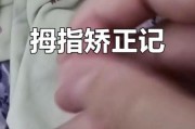 宝宝大拇指伸不直_需要看医生吗