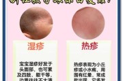 四个月宝宝湿疹最佳治疗方法_宝宝湿疹反复怎么办