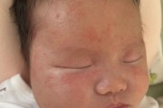 1岁半宝宝脸上长小红疙瘩怎么办_脸上小红疙瘩是什么
