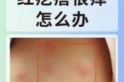 七个月宝宝起红疙瘩图_宝宝红疙瘩怎么办
