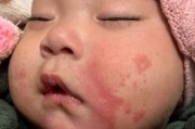 宝宝口水疹图片_如何快速消退