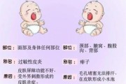8个月宝宝起疹子怎么办_宝宝反复出疹子如何护理
