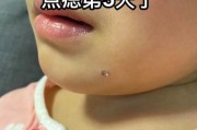 宝宝无色素痣会自己消失吗_宝宝无色素痣怎么治疗