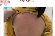 宝宝病毒性疙瘩图片_如何辨别与护理