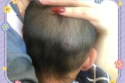 1岁半宝宝摔到后脑勺怎么办_需要去医院吗