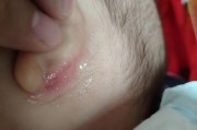 宝宝耳垂下边裂口怎么办_婴儿耳垂裂口护理方法