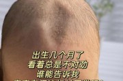 一岁宝宝卤门凹陷正常吗_卤门凹陷怎么办