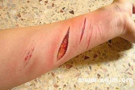 梦到妈妈受伤_梦见母亲受伤预示什么