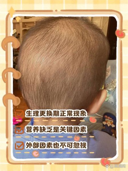 一岁宝宝头发稀少怎么回事_宝宝头发少缺什么营养