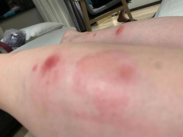 女人梦到狗咬左手出血_梦境解析与心理暗示