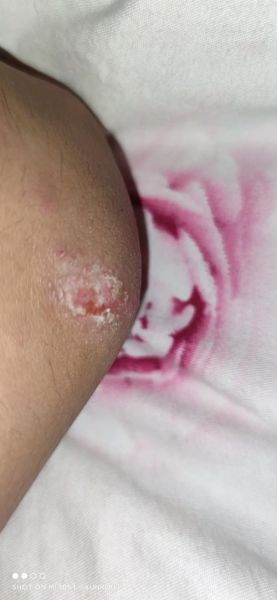 梦到伤口裂开_梦见伤口裂开是什么意思