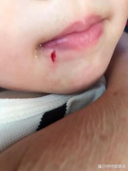 梦到伤口裂开_梦见伤口裂开是什么意思