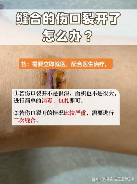 梦到伤口裂开_梦见伤口裂开是什么意思