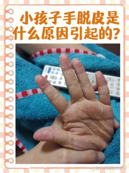 宝宝手指脱皮是怎么回事_宝宝手指脱皮缺什么维生素