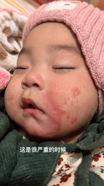 宝宝口水疹图片_如何快速消退