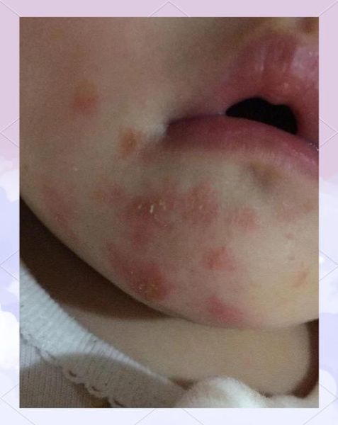 宝宝口水疹图片_如何快速消退