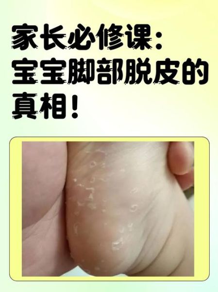 宝宝脚脱皮怎么回事_婴儿脚部脱皮原因