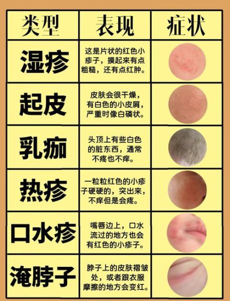 一岁宝宝湿疹怎么办_湿疹反复怎么护理