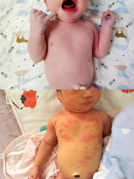 11个月宝宝出疹子症状_怎么办
