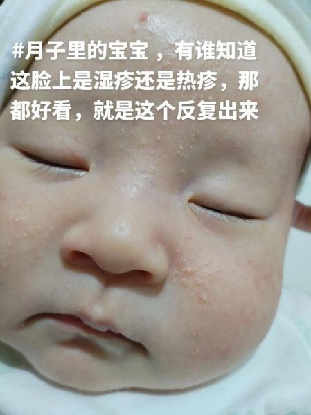 11个月宝宝出疹子症状_怎么办
