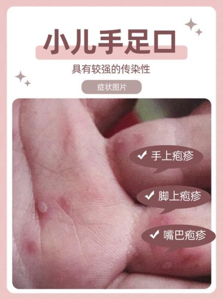 3岁宝宝手足口病初期症状_手足口病怎么治疗