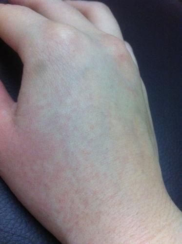 一岁宝宝可以吃螃蟹吗_螃蟹过敏症状