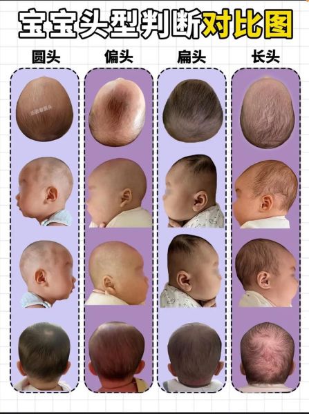 宝宝南北头图片_怎么判断偏头程度
