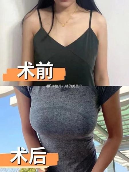 丰胸图片大全_真实效果对比图可信吗