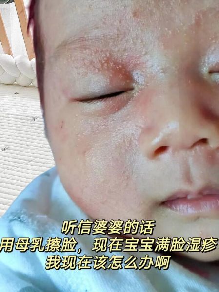 母乳会引起宝宝湿疹吗_湿疹宝宝还能继续母乳吗