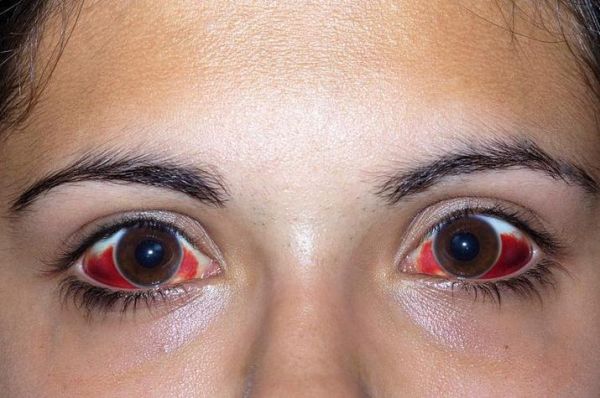 梦到眼睛流血_是什么意思