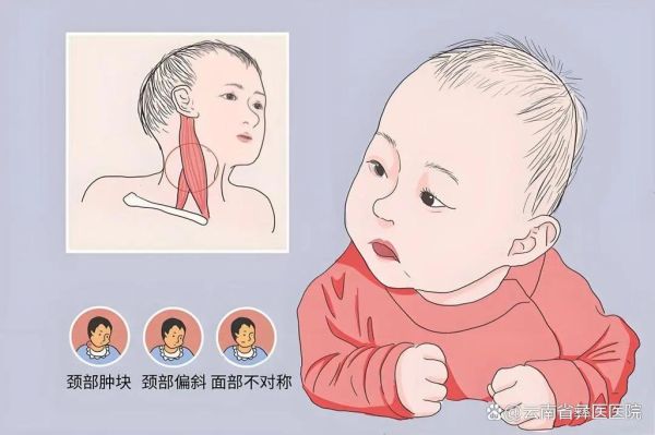 宝宝歪头看东西正常吗_婴儿斜颈如何早期发现