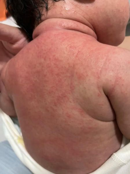 宝宝热痱子症状图片_怎么快速消退