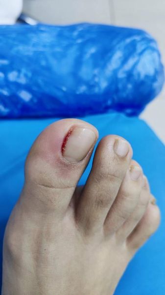 宝宝甲沟炎化脓怎么办_甲沟炎化脓能自愈吗