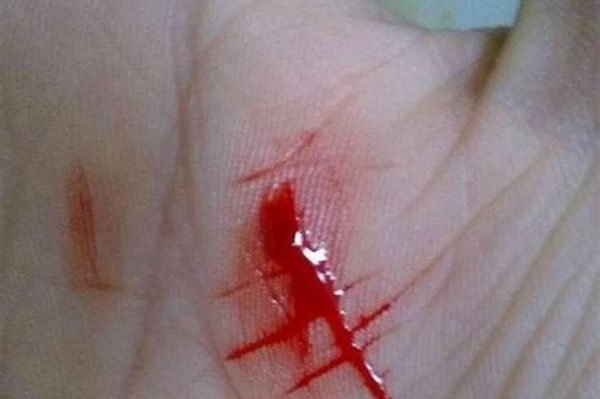 梦到手被刀划破_梦见手受伤流血什么意思