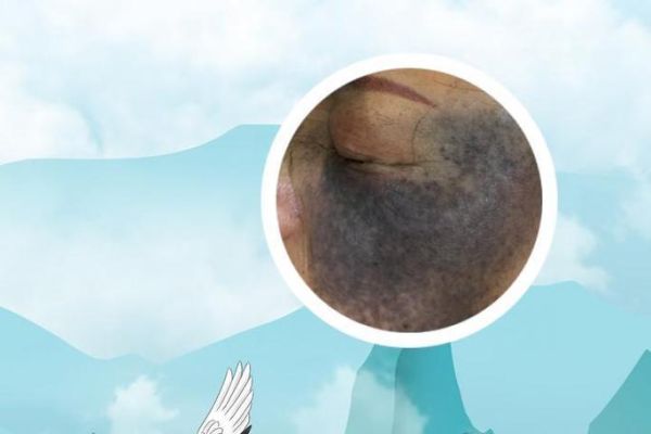 宝宝屁股青色多久会消失_新生儿蒙古斑会变大吗