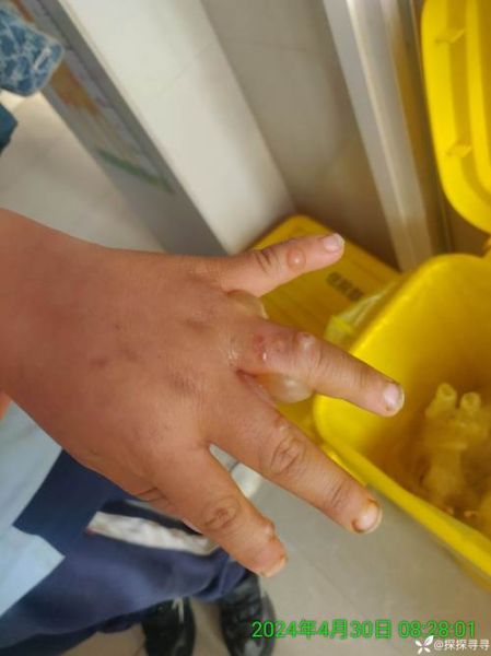 五岁宝宝手上长水泡怎么办_会不会传染