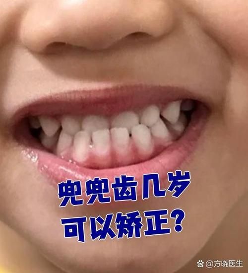 宝宝兜齿怎么办_兜齿几岁矫正最好