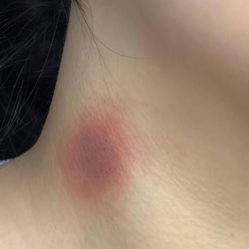 锁骨草莓印怎么消除_草莓印多久能消